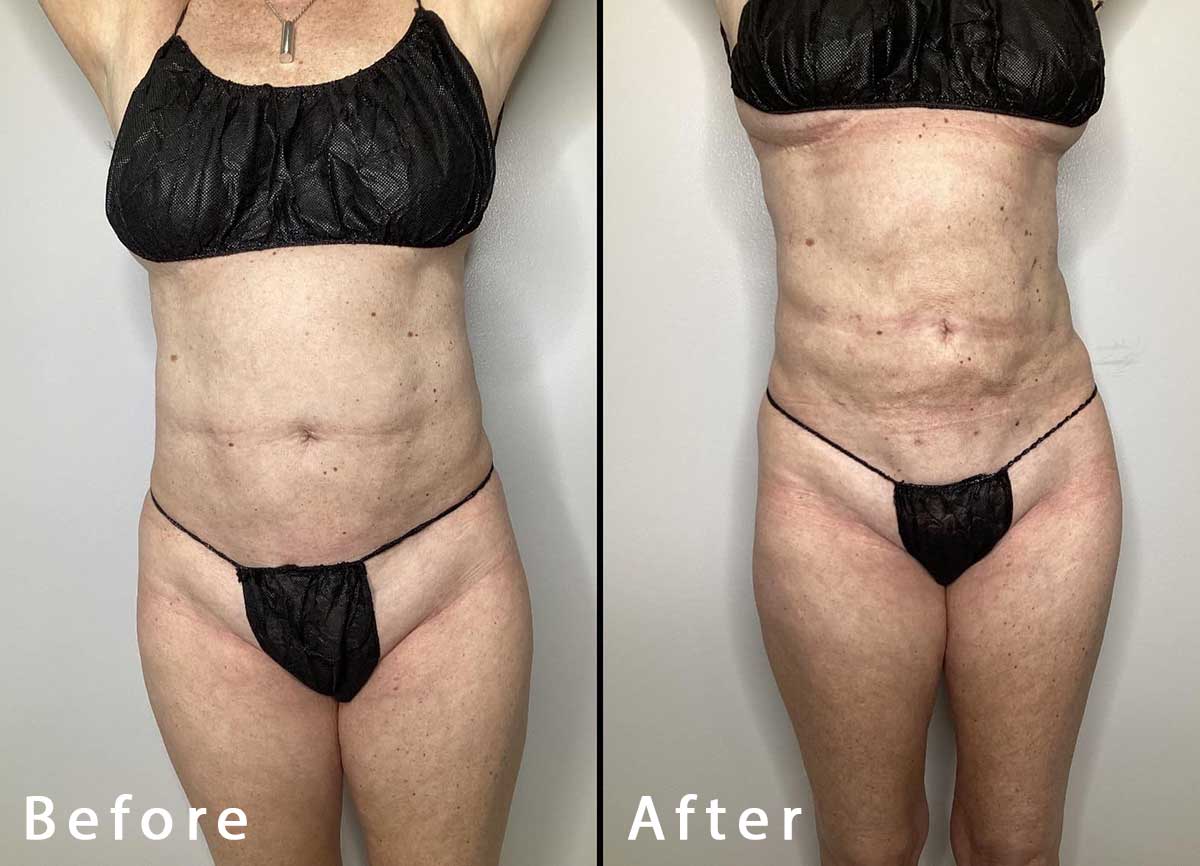 Eves Body Organic MedSpa - Before and After Bra line Lipo